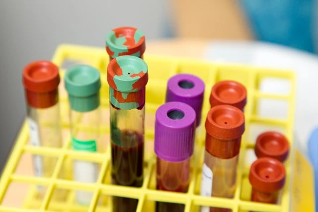 Žlutý stojan s krevními zkumavkami pro laboratorní analýzu.