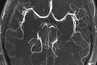 Angiografie mozku zobrazující cévy na MRI snímku.