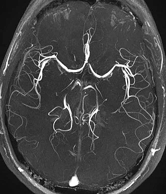 Angiografie mozku zobrazující cévy na MRI snímku.