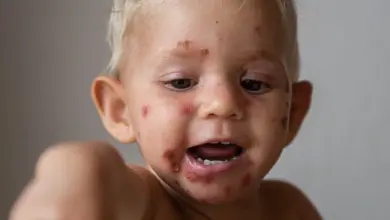 Dítě s vyrážkou zvané impetigo na obličeji.
