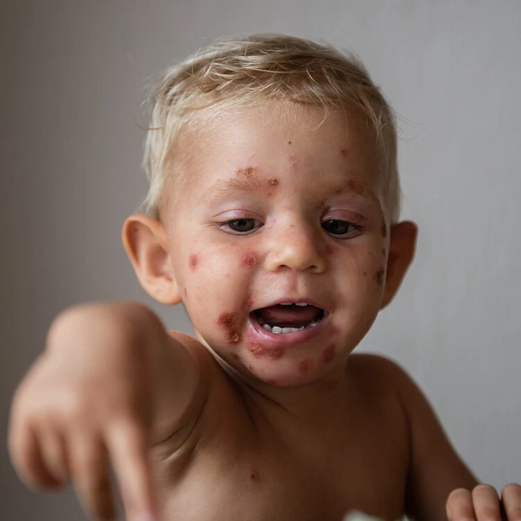 Dítě s vyrážkou zvané impetigo na obličeji.
