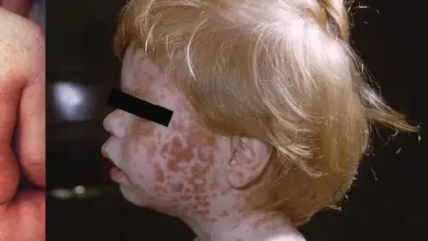 Child with erythema infectiosum rash