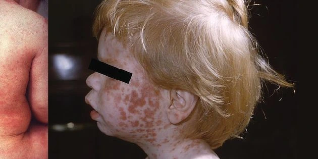 Child with erythema infectiosum rash