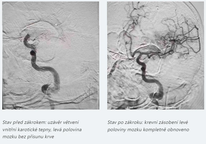 Angiografie mozkové tepny před a po zavedení stentu