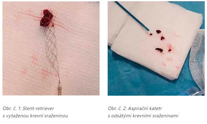 Stent-retriever s krevní sraženinou po extrakci z mozkové cévy